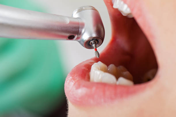 Best Emergency Wisdom Tooth Extraction in San Angelo, TX